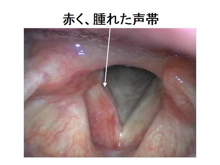 101：声帯炎・喉頭炎.JPG